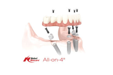 All-on-4 terapija