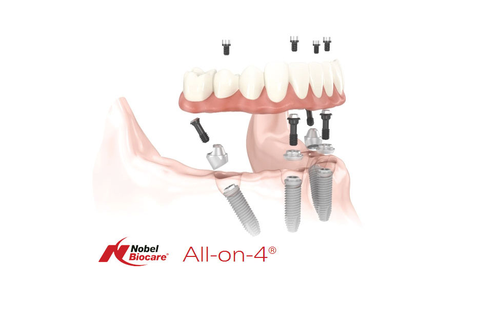 All-on-4 terapija