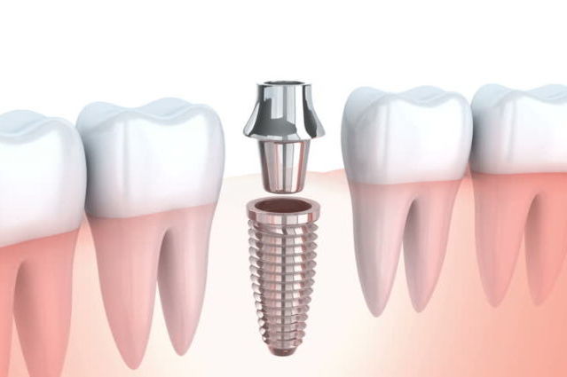 Što opravdava cijenu zubnih implantata?