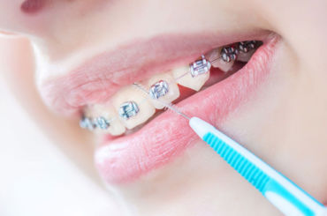 Oralna higijena za vrijeme trajanja ortodontske terapije